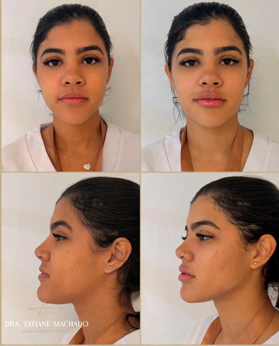 Antes e depois - Harmonização Orofacial