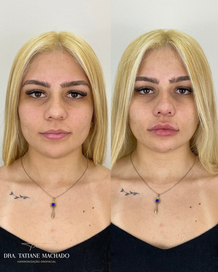 Antes e depois - Harmonização facial