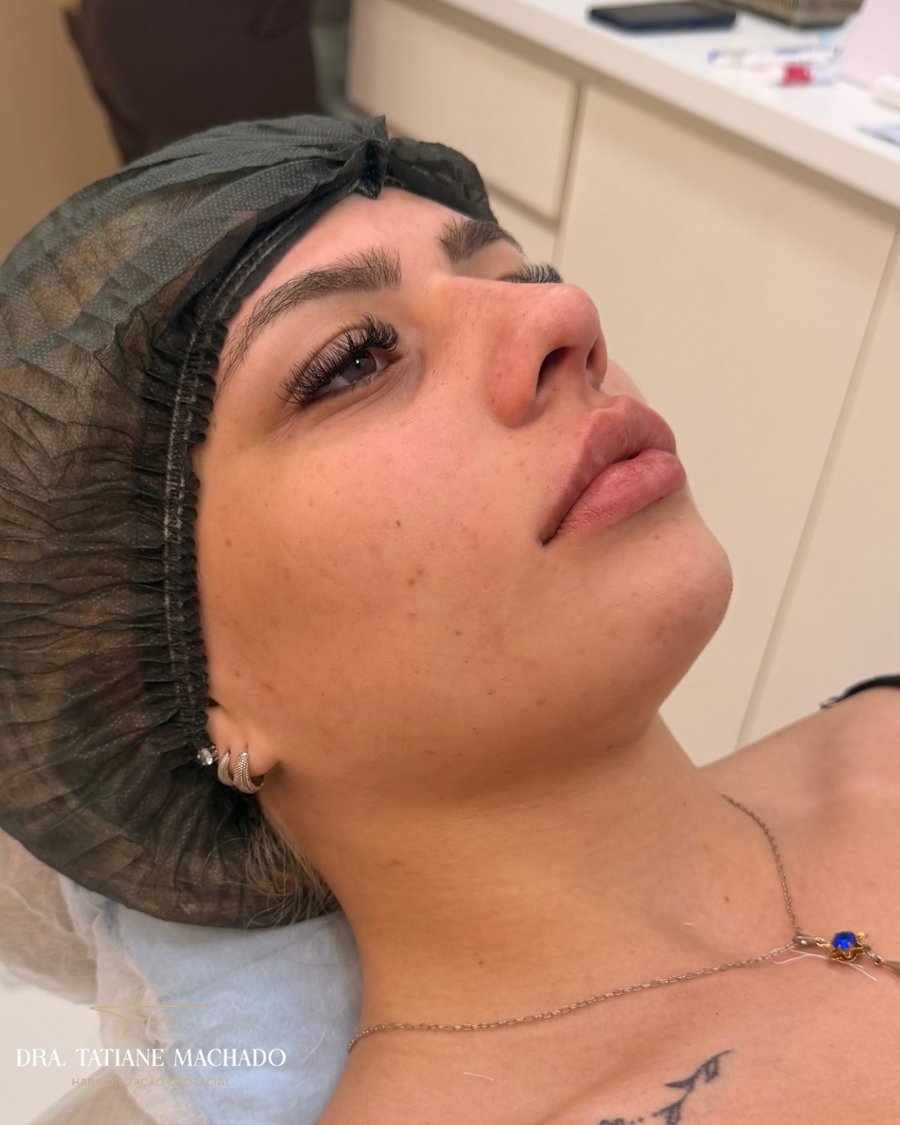 Harmonização Orofacial - Dra. Tatiane Machado